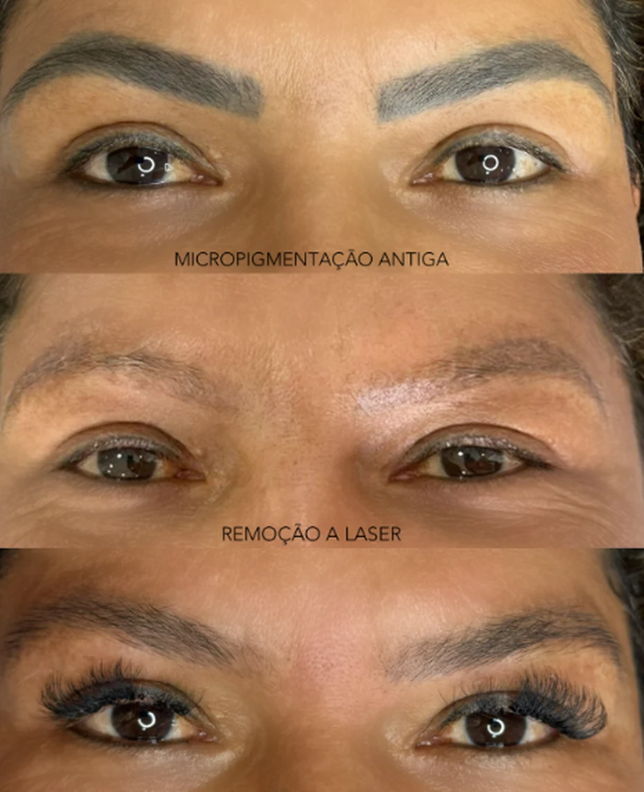 Antes e depois: micropigmentação antiga, remoção a laser e reconstrução das sobrancelhas