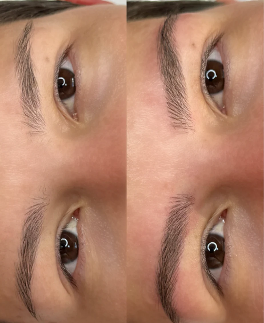 Sobrancelhas com nanofios, antes e depois